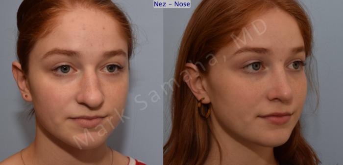 Before & After Rhinoplastie / Rhinoplasty Case 108 View #8 View in Mount Royal, QC