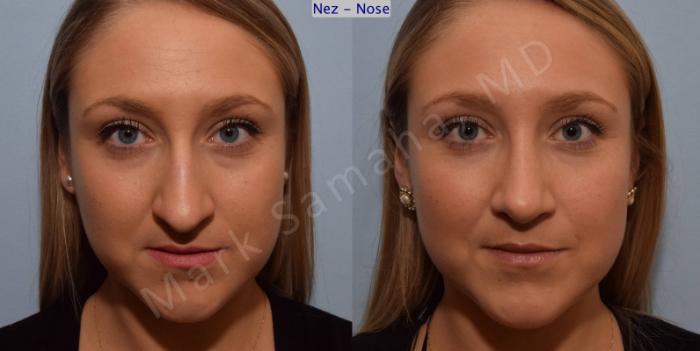 Before & After Rhinoplastie / Rhinoplasty Case 109 View #1 View in Montreal, QC
