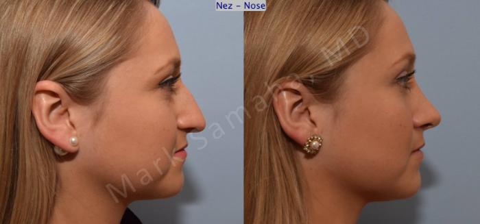 Before & After Rhinoplastie / Rhinoplasty Case 109 View #4 View in Montreal, QC
