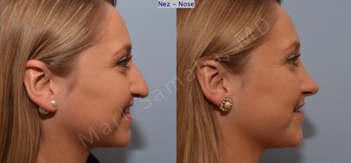 Before & After Rhinoplastie / Rhinoplasty Case 109 View #5 View in Montreal, QC