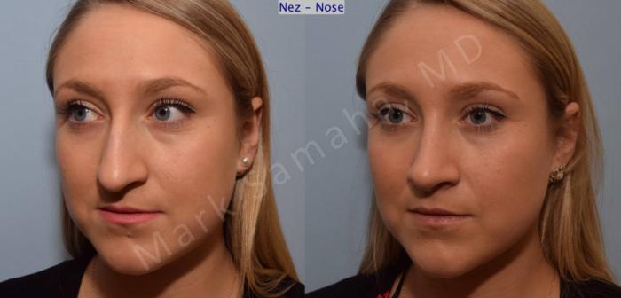 Before & After Rhinoplastie / Rhinoplasty Case 109 View #6 View in Montreal, QC