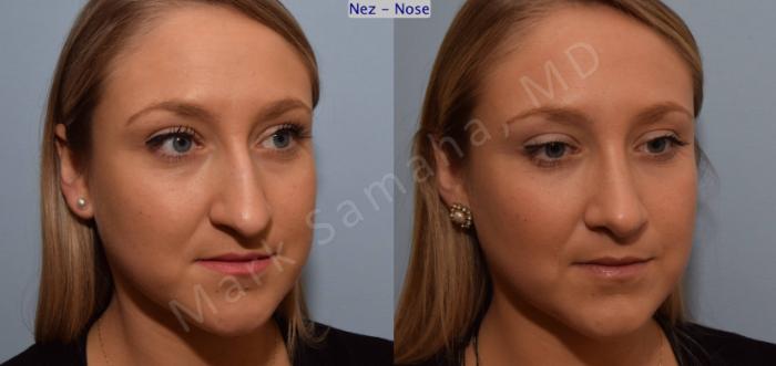 Before & After Rhinoplastie / Rhinoplasty Case 109 View #7 View in Montreal, QC