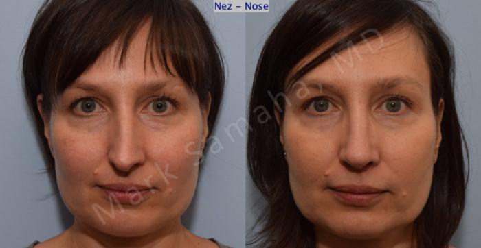Before & After Rhinoplastie / Rhinoplasty Case 110 View #1 View in Montreal, QC