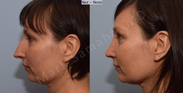 Before & After Rhinoplastie / Rhinoplasty Case 110 View #2 View in Montreal, QC