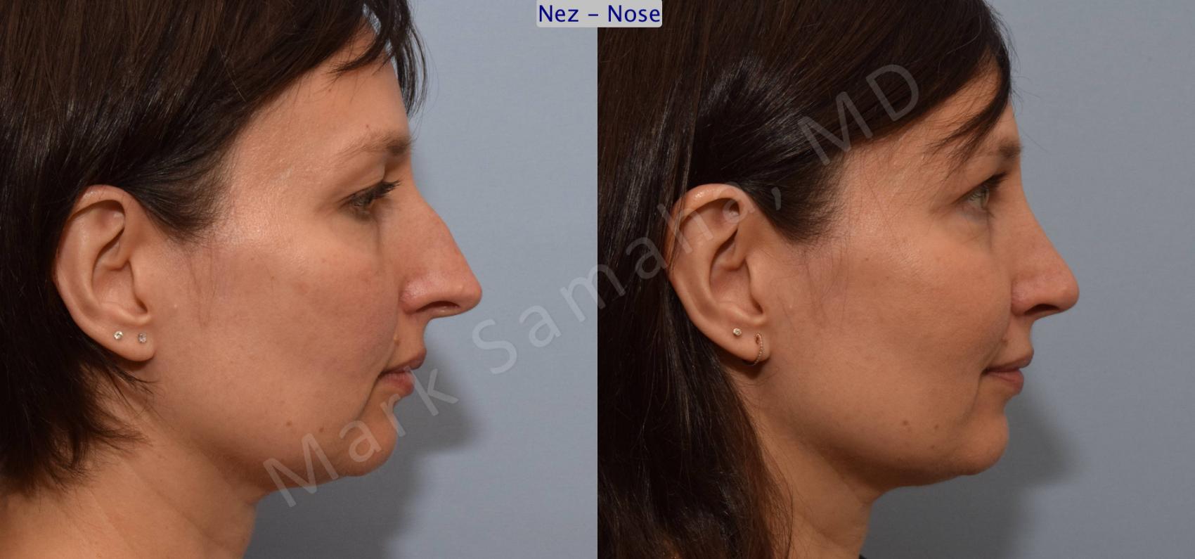 Before & After Rhinoplastie / Rhinoplasty Case 110 View #4 View in Montreal, QC