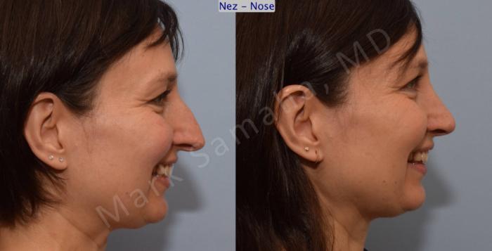 Before & After Rhinoplastie / Rhinoplasty Case 110 View #5 View in Montreal, QC