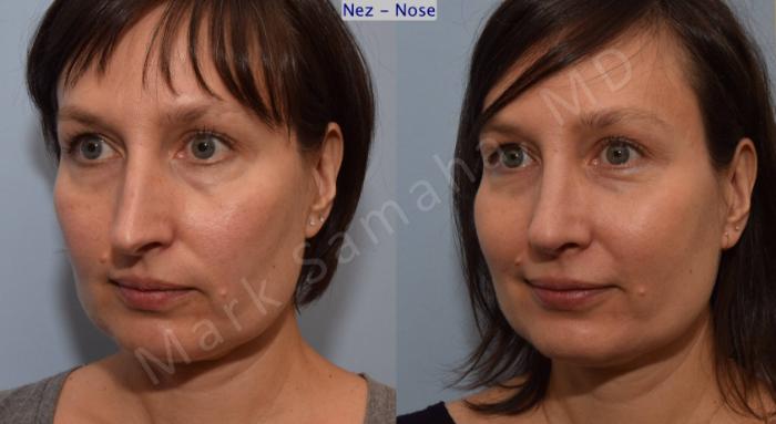 Before & After Rhinoplastie / Rhinoplasty Case 110 View #6 View in Montreal, QC