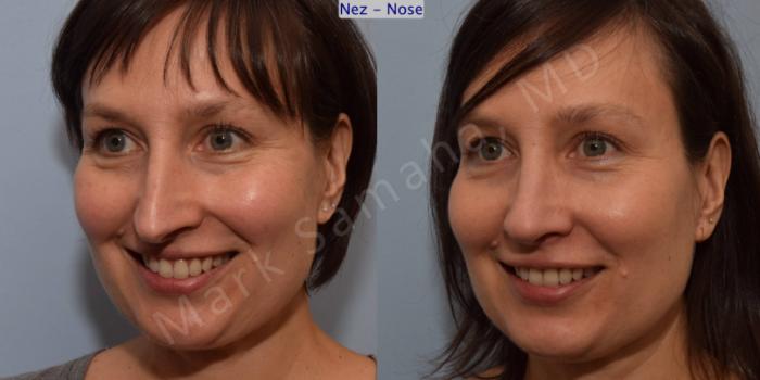 Before & After Rhinoplastie / Rhinoplasty Case 110 View #7 View in Montreal, QC