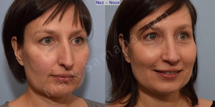 Before & After Rhinoplastie / Rhinoplasty Case 110 View #8 View in Montreal, QC