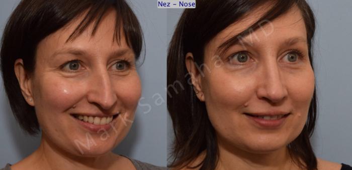 Before & After Rhinoplastie / Rhinoplasty Case 110 View #9 View in Montreal, QC