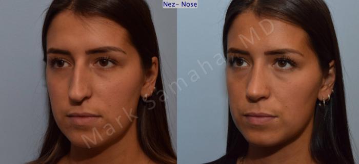 Before & After Rhinoplastie / Rhinoplasty Case 114 View #3 View in Montreal, QC