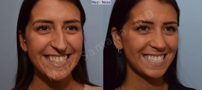 Before & After Rhinoplastie / Rhinoplasty Case 114 View #4 View in Montreal, QC
