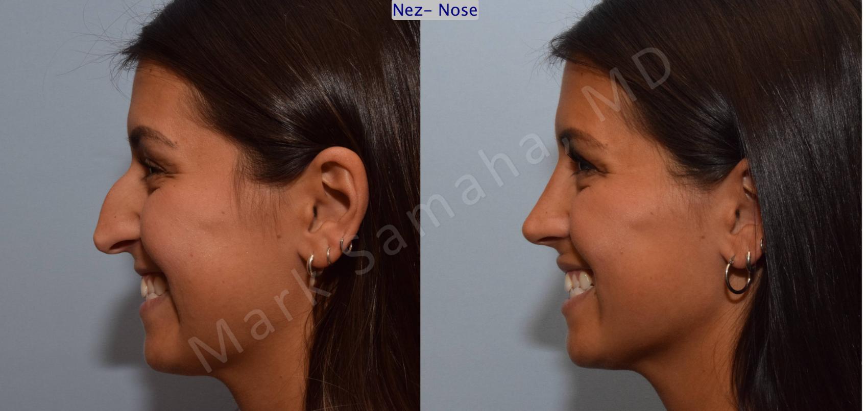 Before & After Rhinoplastie / Rhinoplasty Case 114 View #6 View in Montreal, QC