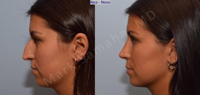 Before & After Rhinoplastie / Rhinoplasty Case 114 View #7 View in Montreal, QC