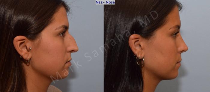 Before & After Rhinoplastie / Rhinoplasty Case 114 View #9 View in Montreal, QC