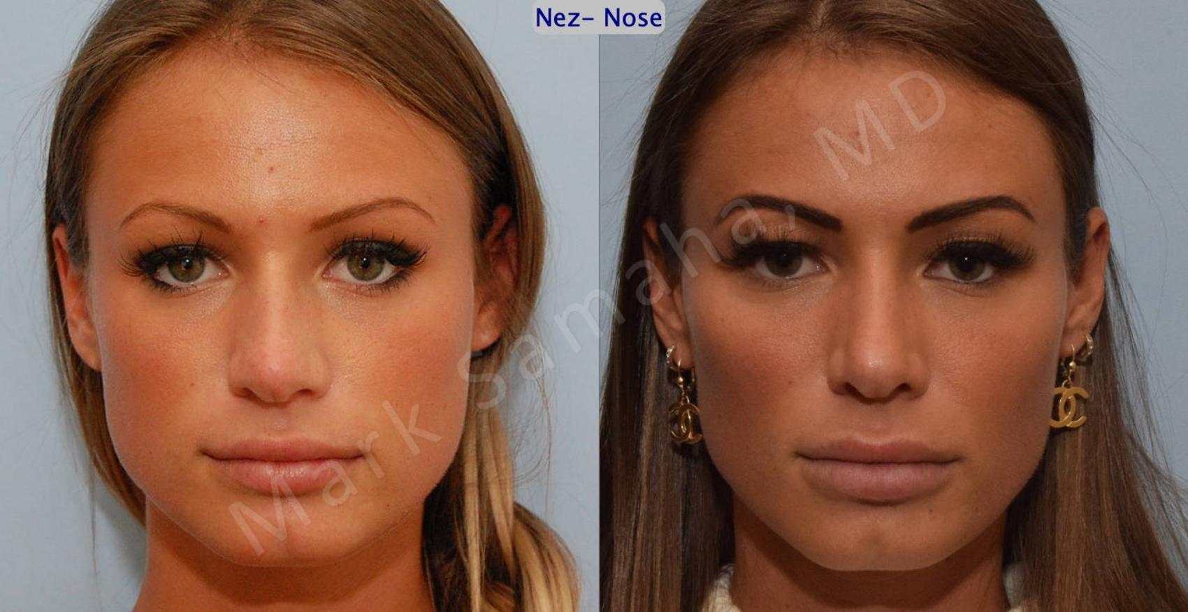 Before & After Rhinoplastie / Rhinoplasty Case 123 View #1 View in Montreal, QC
