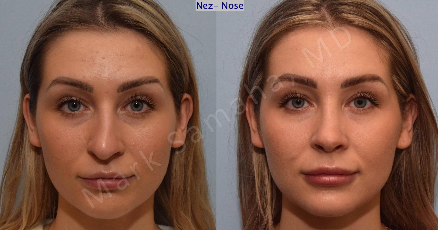 Before & After Rhinoplastie / Rhinoplasty Case 125 View #1 View in Montreal, QC