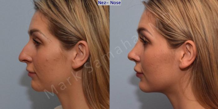 Before & After Rhinoplastie / Rhinoplasty Case 125 View #3 View in Montreal, QC