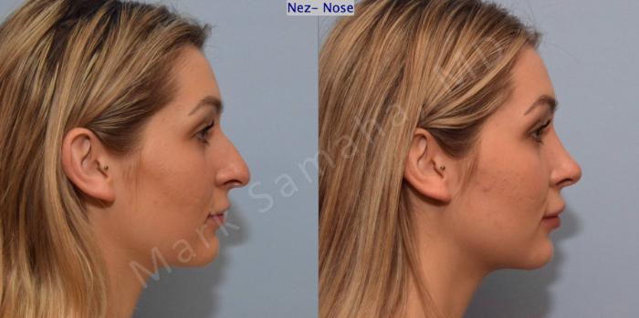Before & After Rhinoplastie / Rhinoplasty Case 125 View #4 View in Montreal, QC