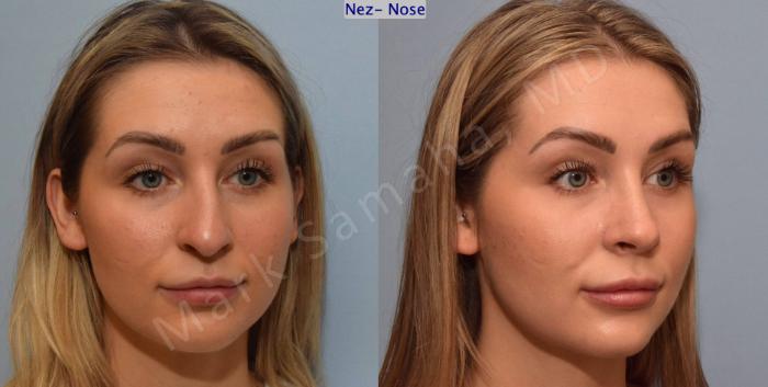 Before & After Rhinoplastie / Rhinoplasty Case 125 View #5 View in Montreal, QC