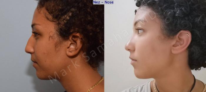 Before & After Rhinoplastie / Rhinoplasty Case 141 Left Side View in Montreal, QC