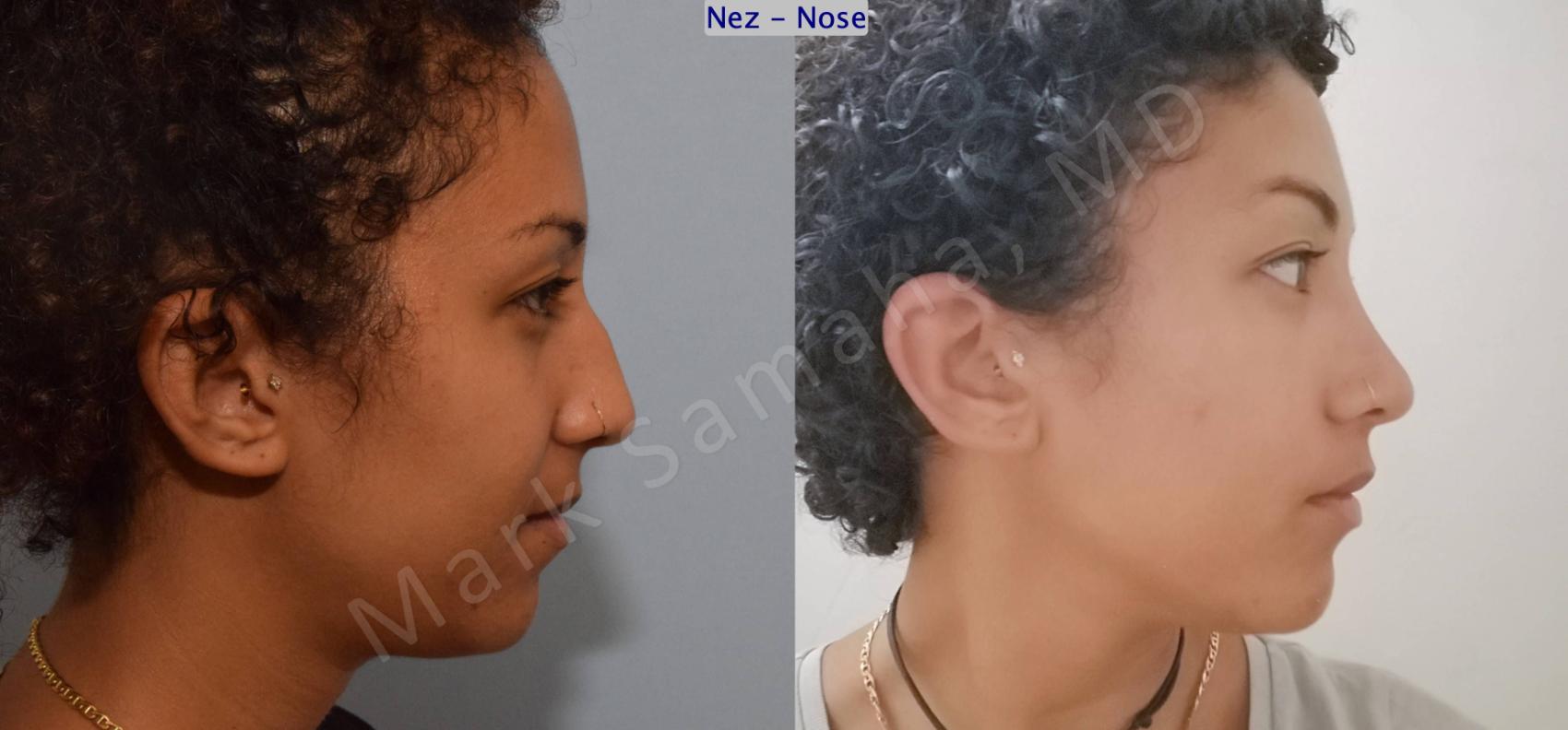 Before & After Rhinoplastie / Rhinoplasty Case 141 Right Side View in Montreal, QC