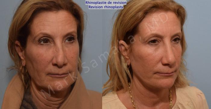 Before & After Rhinoplastie / Rhinoplasty Case 181 Right Oblique View in Montreal, QC