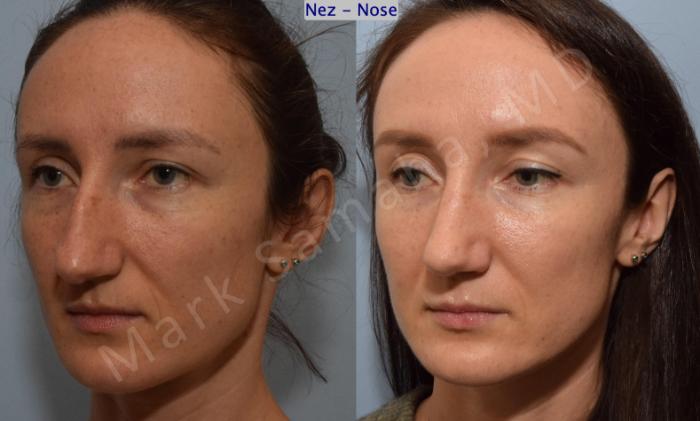 Before & After Rhinoplastie / Rhinoplasty Case 182 Left Oblique View in Montreal, QC