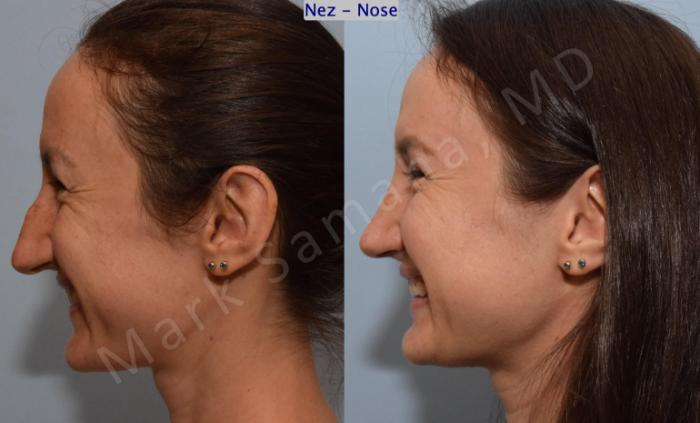 Before & After Rhinoplastie / Rhinoplasty Case 182 Left Side Smile View in Montreal, QC
