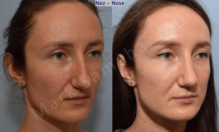 Before & After Rhinoplastie / Rhinoplasty Case 182 Right Oblique View in Montreal, QC
