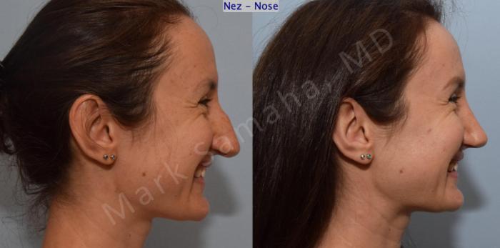 Before & After Rhinoplastie / Rhinoplasty Case 182 Right Side Smile View in Montreal, QC