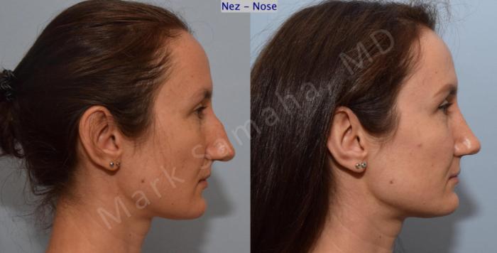 Before & After Rhinoplastie / Rhinoplasty Case 182 Right Side View in Montreal, QC