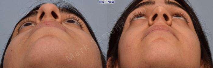 Before & After Rhinoplastie / Rhinoplasty Case 183 Basal View in Montreal, QC