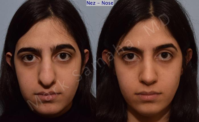 Before & After Rhinoplastie / Rhinoplasty Case 183 Front View in Montreal, QC
