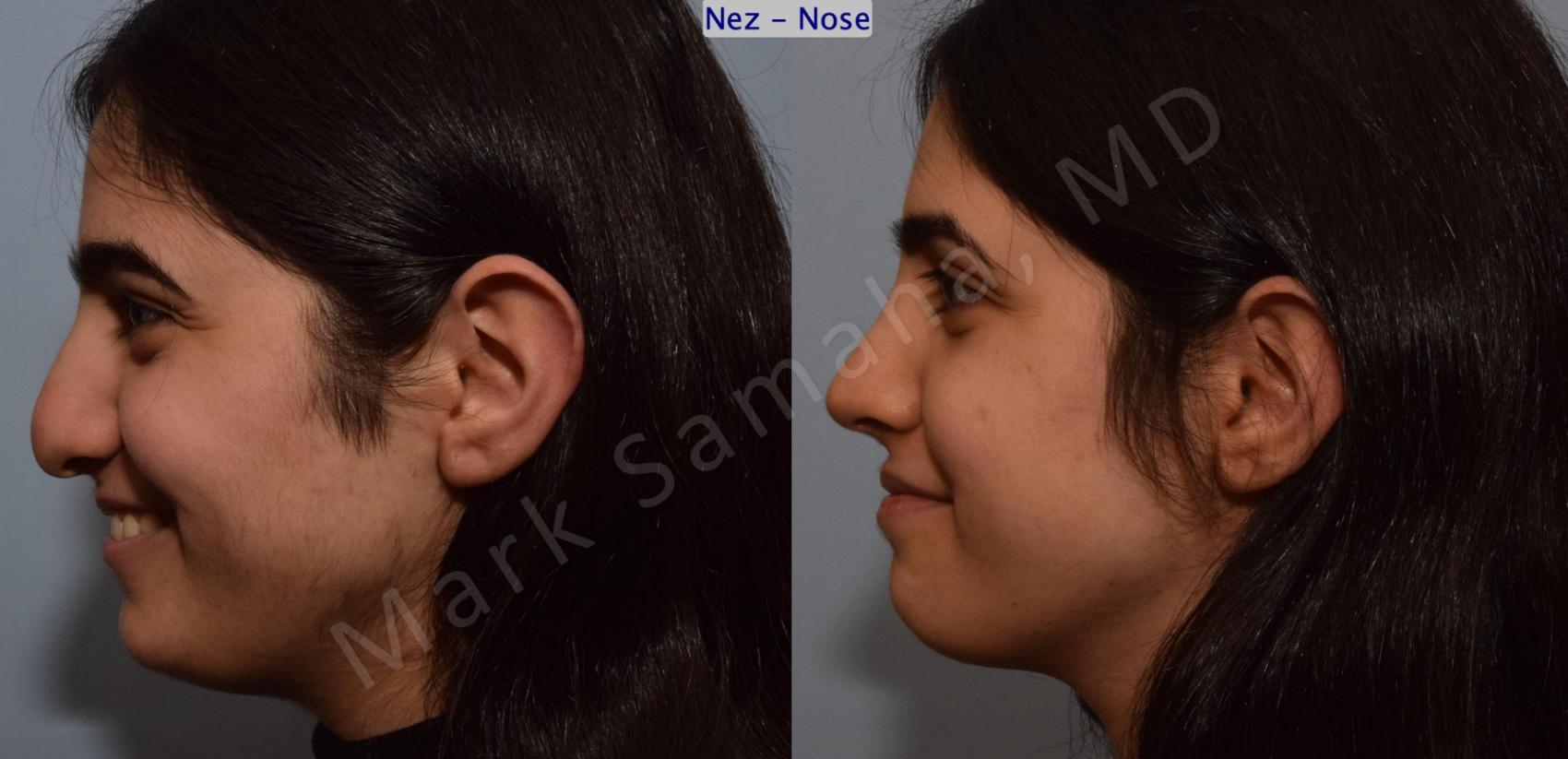 Before & After Rhinoplastie / Rhinoplasty Case 183 Left Side Smile View in Montreal, QC