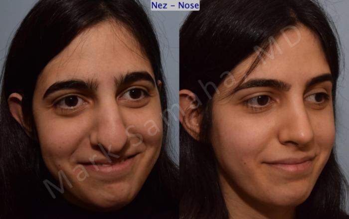 Before & After Rhinoplastie / Rhinoplasty Case 183 Right Oblique Smile  View in Montreal, QC