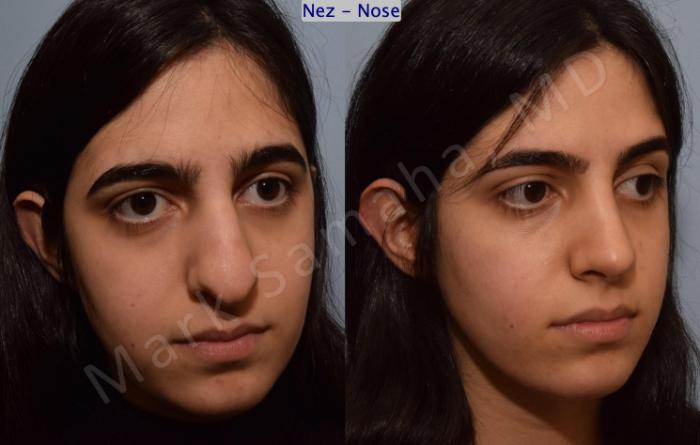 Before & After Rhinoplastie / Rhinoplasty Case 183 Right Oblique View in Montreal, QC