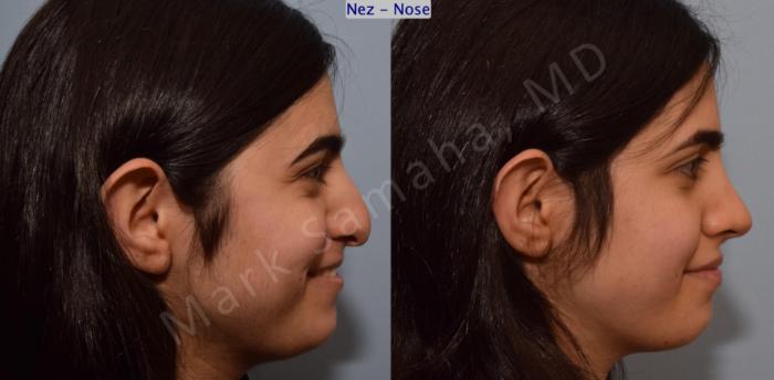 Before & After Rhinoplastie / Rhinoplasty Case 183 Right Side Smile  View in Montreal, QC