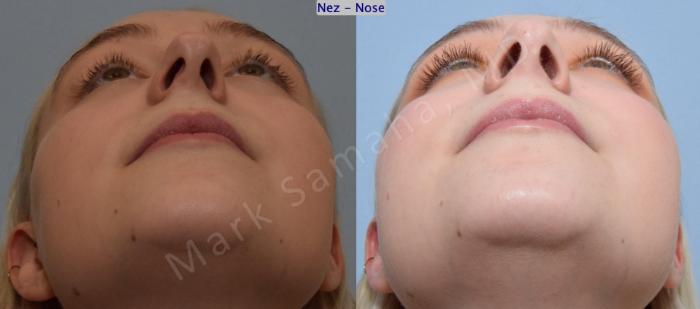 Before & After Rhinoplastie / Rhinoplasty Case 184 Basal View in Mount Royal, QC