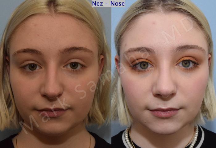 Before & After Rhinoplastie / Rhinoplasty Case 184 Front View in Montreal, QC