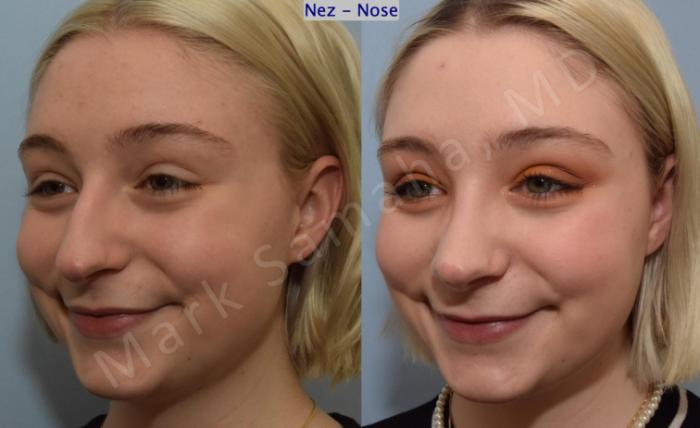 Before & After Rhinoplastie / Rhinoplasty Case 184 Left Oblique Smile View in Montreal, QC