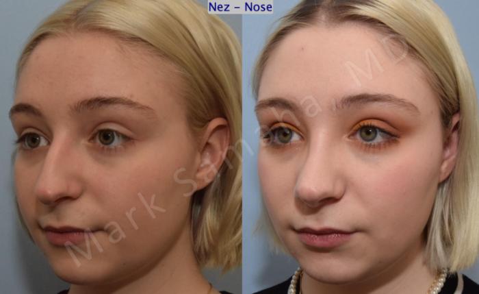 Before & After Rhinoplastie / Rhinoplasty Case 184 Left Oblique View in Mount Royal, QC