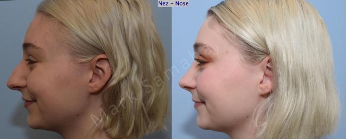 Before & After Rhinoplastie / Rhinoplasty Case 184 Left Profile Smile  View in Mount Royal, QC