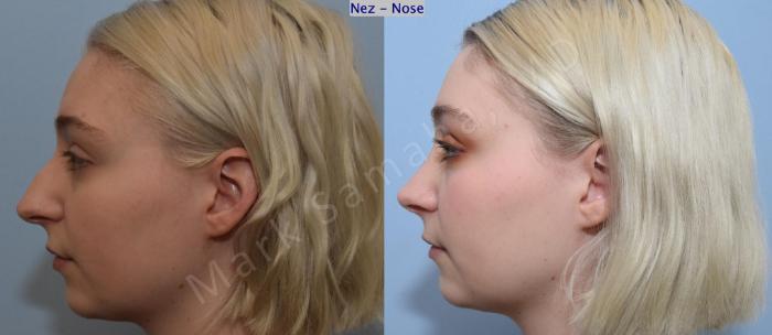 Before & After Rhinoplastie / Rhinoplasty Case 184 Left Side View in Montreal, QC