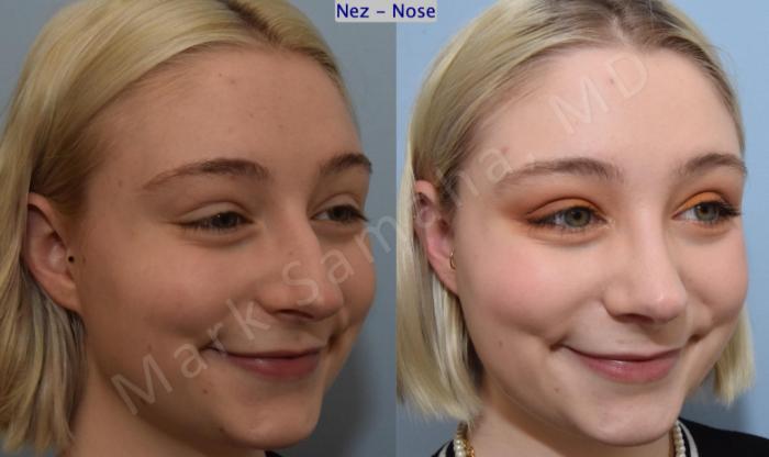 Before & After Rhinoplastie / Rhinoplasty Case 184 Right Oblique Smile View in Mount Royal, QC