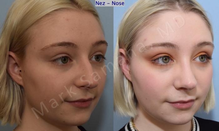 Before & After Rhinoplastie / Rhinoplasty Case 184 Right Oblique View in Montreal, QC