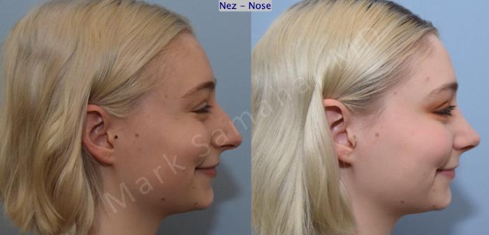 Before & After Rhinoplastie / Rhinoplasty Case 184 Right Profile Smile  View in Mount Royal, QC