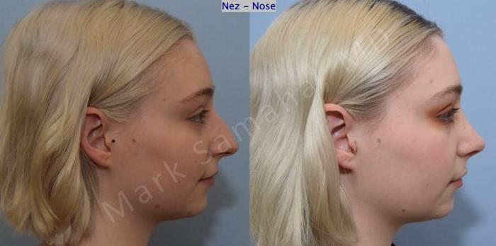 Before & After Rhinoplastie / Rhinoplasty Case 184 Right Side View in Montreal, QC