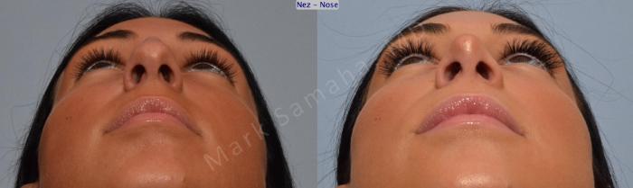 Before & After Rhinoplastie / Rhinoplasty Case 185 Basal View in Montreal, QC