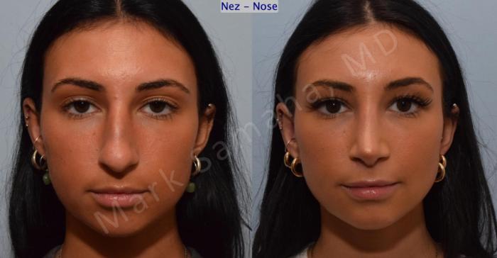 Before & After Rhinoplastie / Rhinoplasty Case 185 Front View in Montreal, QC